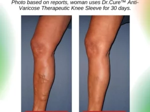 Dr.Cure™ Anti-Varicose Therapeutic Knee Sleeve