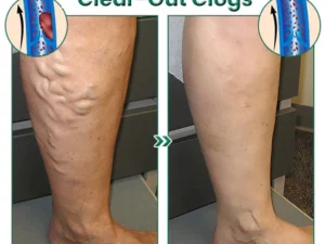 EL VITA Varicose Veins Treatment Soap