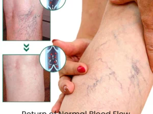 EL VITA Varicose Veins Treatment Soap