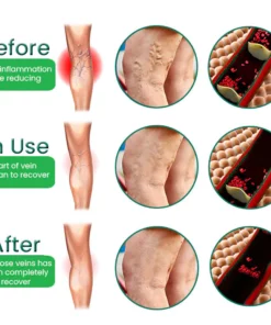 EL VITA Varicose Veins Treatment Soap