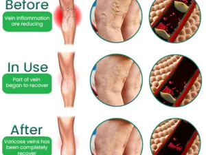 EL VITA Varicose Veins Treatment Soap