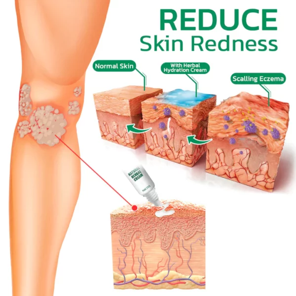 Crema d'hidratació d'herbes EczemaTherapy