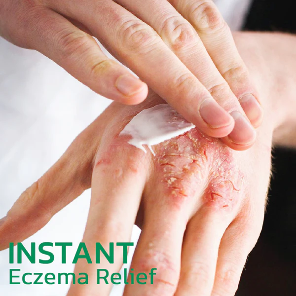 Krim Penyembuhan Herbal EczmoTherapy