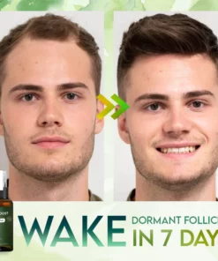 FolliBoost Hair Regrowth Spray