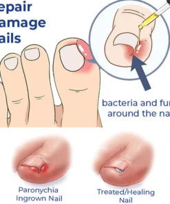 German ToenailCare™ Removal Paronychia Oil