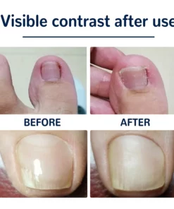 German ToenailHeal Paronychia Relief Patch