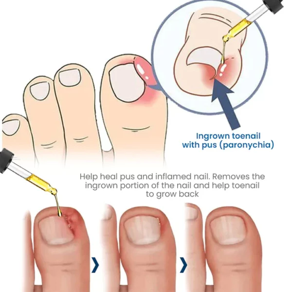 Harivian® Anti-Paronychie-Öl zur Linderung