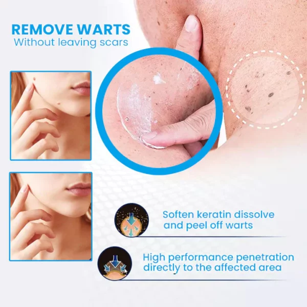 Ungüento Eliminador de Verrugas Instant PLUS