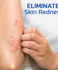 KoTinea Soothing Ointment