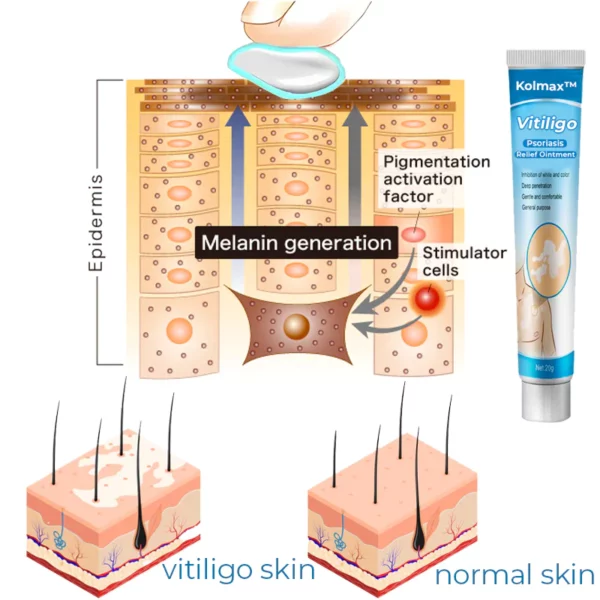 Pomada calmante Kolmax™ para el vitíligo