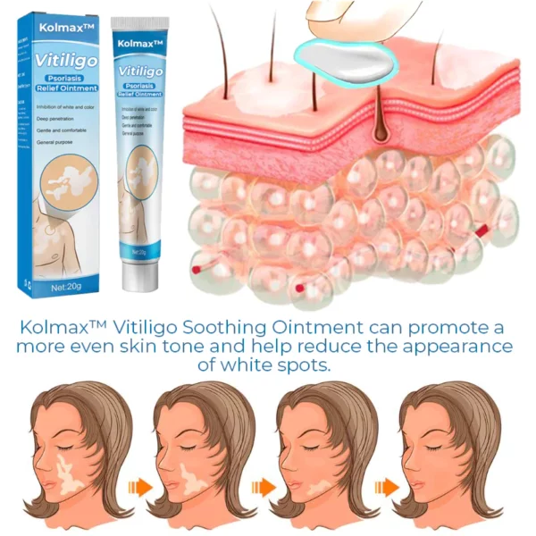 Kolmax™ Vitiligo Yatıştırıcı Merhem