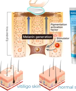 Kolmax™ Vitiligo Soothing Ointment