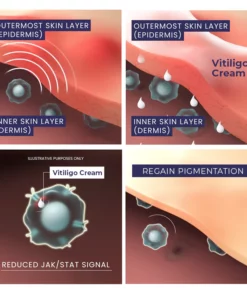 MEDix™ Vitiligo Relief Spray