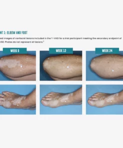 MEDix™ Vitiligo Relief Spray