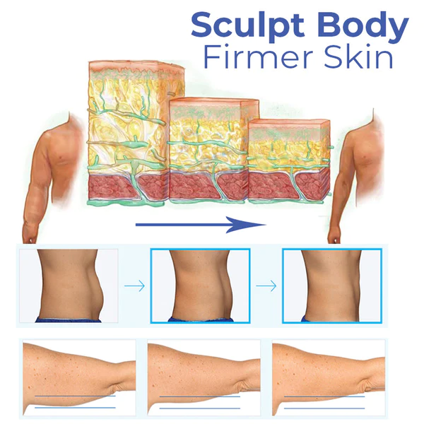 Gel CoolSculpting Tepat Nagasaki DermoFreeze™