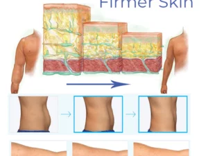 Nagasaki DermoFreeze™ Precise CoolSculpting Gel