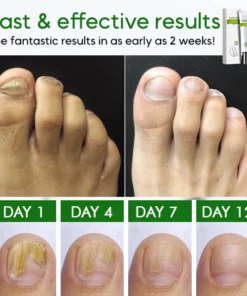 NailCare™ Toe Nail Treatment Gel