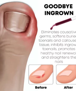 NailRelief AntiParonychia Herbal Oil