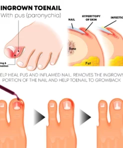 NailRelief AntiParonychia Herbal Oil