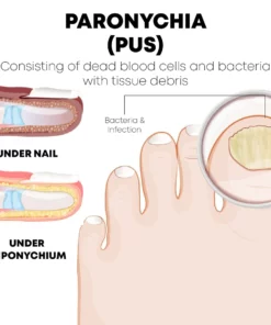 NailRelief AntiParonychia Herbal Oil