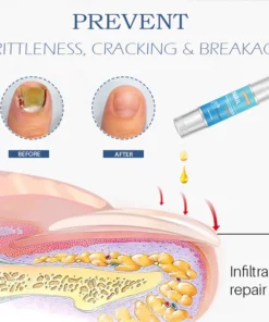 Bolígraf de tractament de fongs de renovació de les ungles