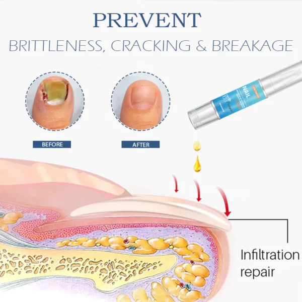 Nail Renewal FungusTreatment Pen