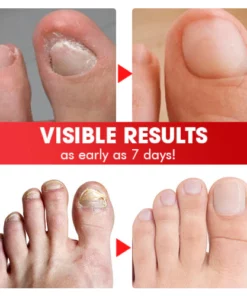 Nailcare™ Ingrown Toe Nail Drops