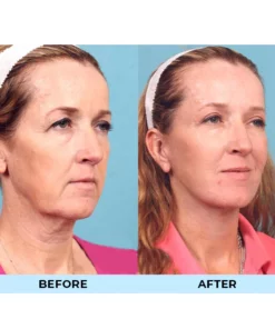 OSUFI™ Revolution-V Face Shaper