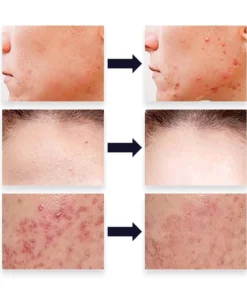 PUREOrganic WartRemover Cream