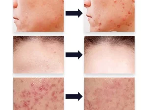 PUREOrganic WartRemover Cream