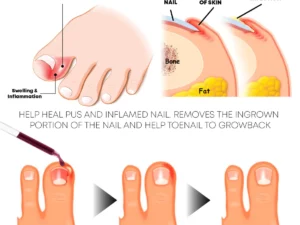 PediPerfect AntiParonychia Relief Oil