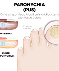 PediPerfect AntiParonychia Relief Oil