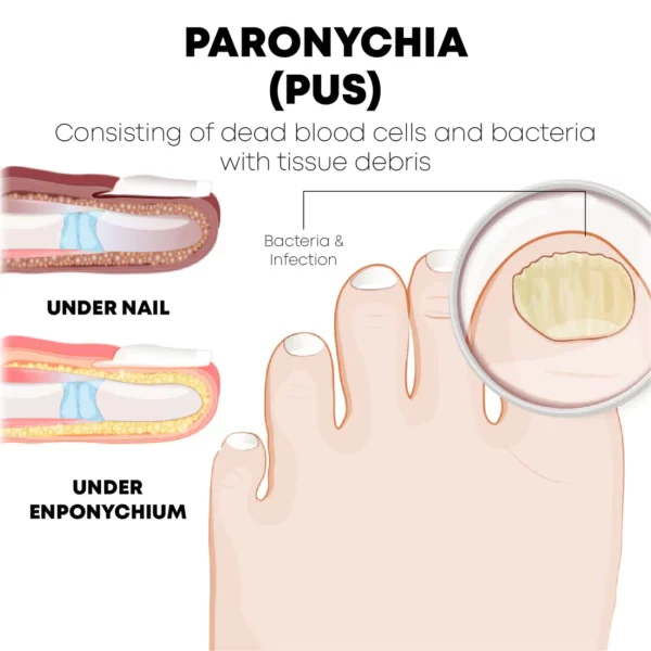 PediPerfect AntiParonychia റിലീഫ് ഓയിൽ