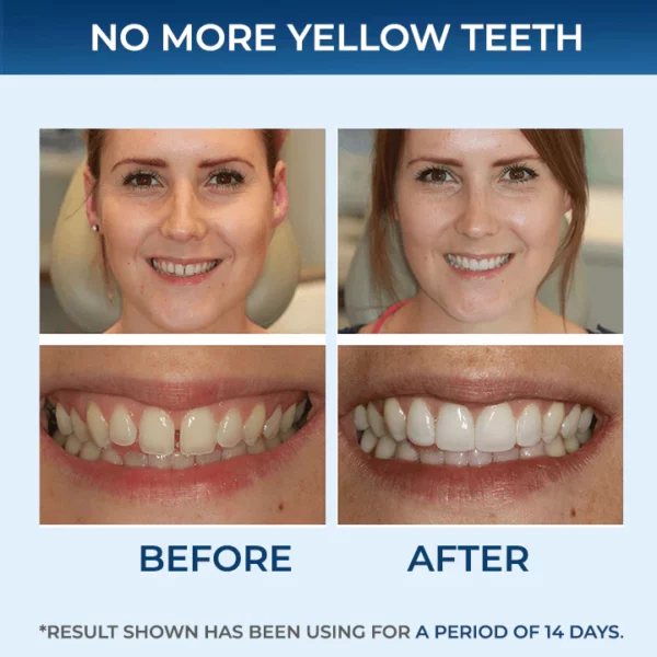 Tiras blanqueadoras de dientes SMILEKIT® 5D