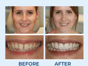 SMILEKIT® 5D Teeth Whitening Strips