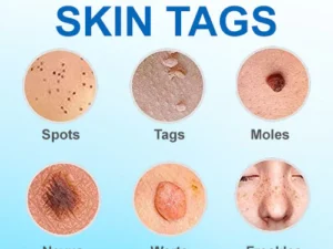 SkinCare™ Tags Remover Cream