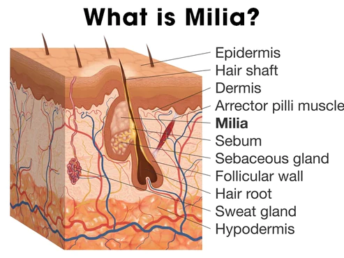 SkinPro Milia tisztító szérum