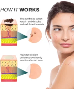 SpotOff SkinTag RemoverPatches