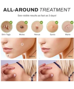 SpotOff SkinTag RemoverPatches