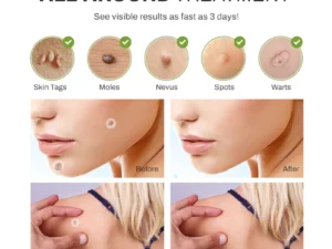 SpotOff SkinTag RemoverPatches