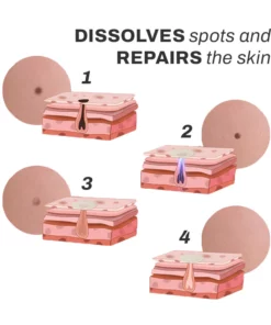 SpotOff SkinTag RemoverPatches