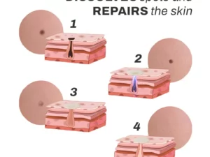 SpotOff SkinTag RemoverPatches