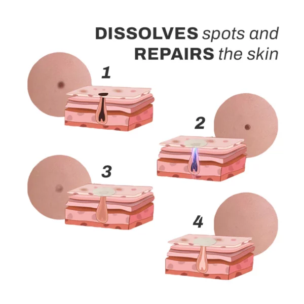 I-SpotOff SkinTag RemoverPatches