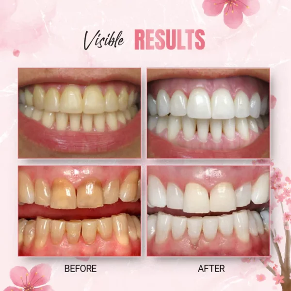 WhiteLab™ Teeth Noda Strips Whitening