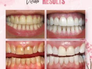 WhiteLab™ Teeth Stain Removal Whitening Strips
