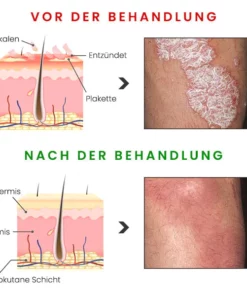 BIORAMAX PRO PsoriaRescue Behandlung Spray