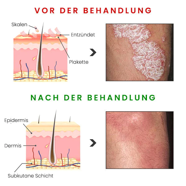 BIORAMAX PRO PsoriaRescue Behandlung Spray