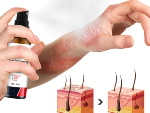 BIORAMAX PsoriaRescue Behandlung Spray