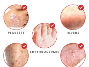 BIORAMAX PsoriaRescue Behandlung Spray