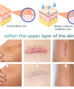 Bioskin™ Advanced Scar Removal Gel